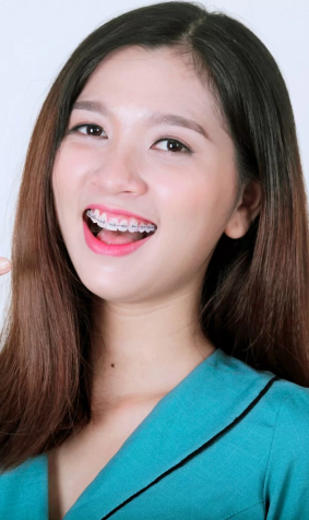 Dịch Vụ Niềng Răng